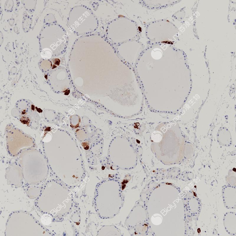 甲状腺Procalcitonin（BP6237）染色