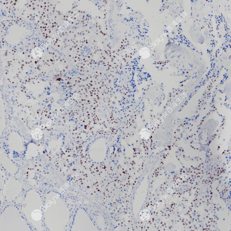 甲状腺髓样癌INSM-1（BP6240）染色