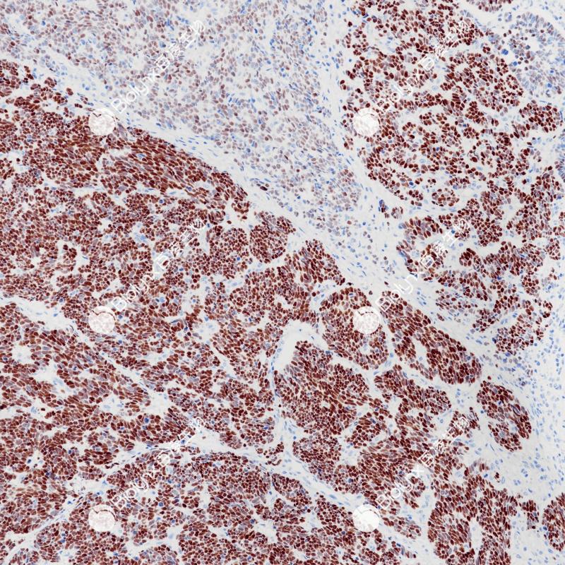 小细胞神经内分泌癌INSM1（BP6240）染色