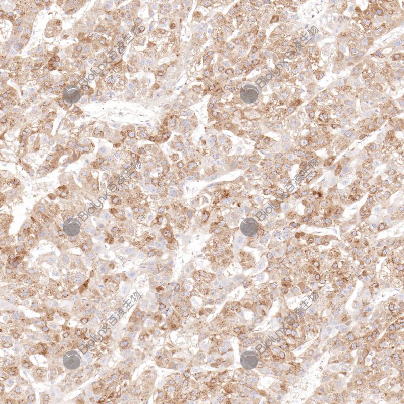 肝细胞肝癌AFP（BP6244）染色