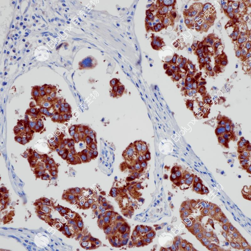 胰腺癌IMP-3(BP6264)染色