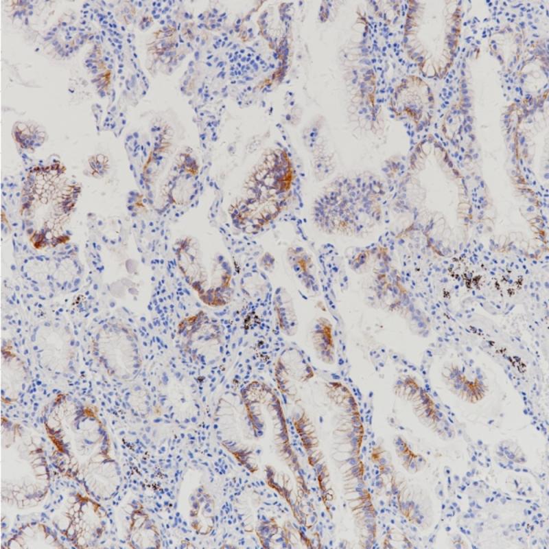 肺腺癌Claudin 18.2（BP6249）染色