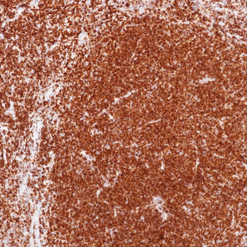 滤泡性淋巴瘤Bcl-2(8C8)染色