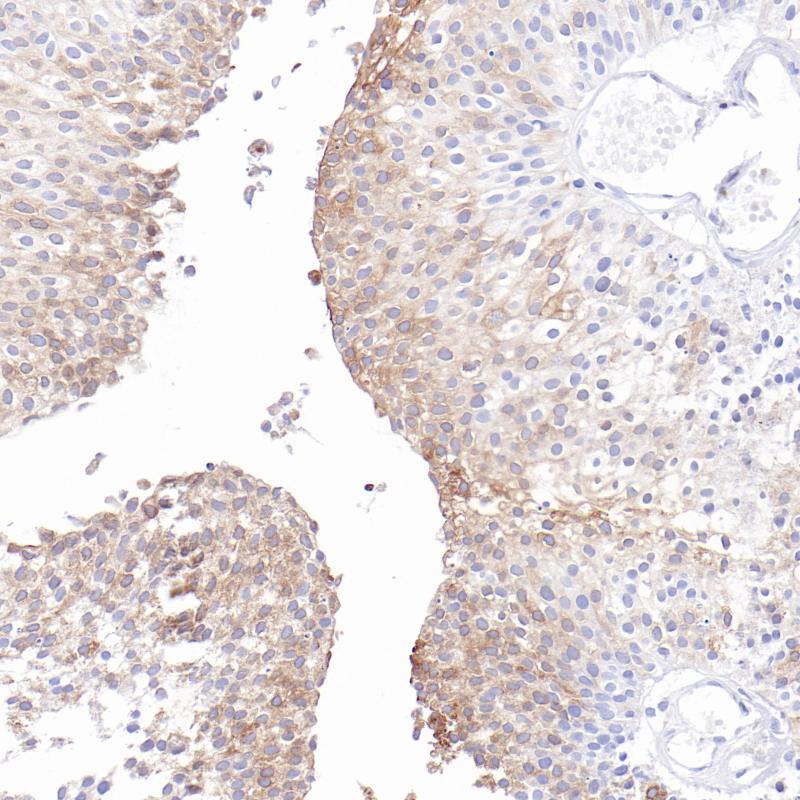 尿路上皮癌Uroplakin Ib（BP6310）染色