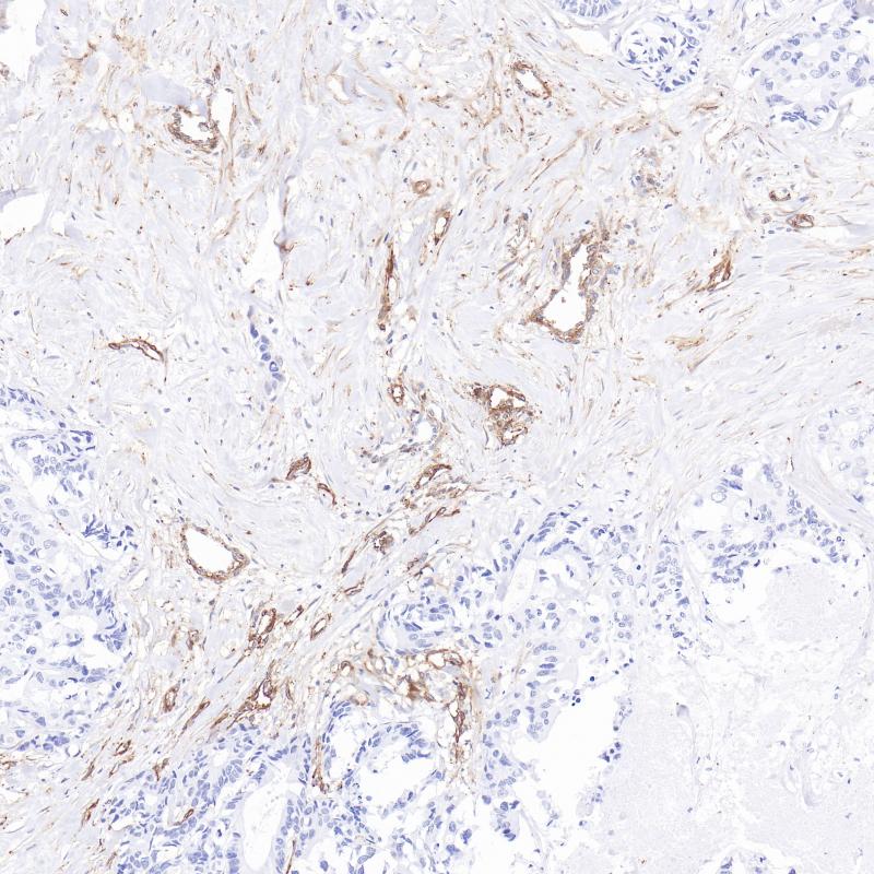 结肠癌CD90（BP6322）染色