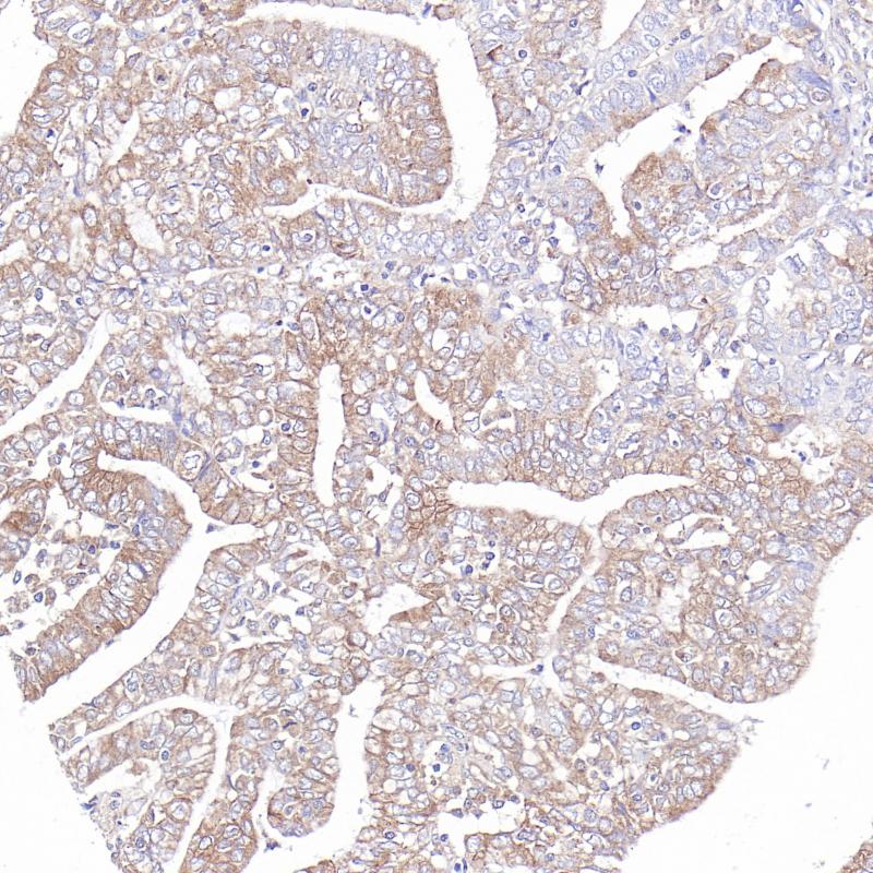 乳腺癌TMPRSS4(BP6327)染色