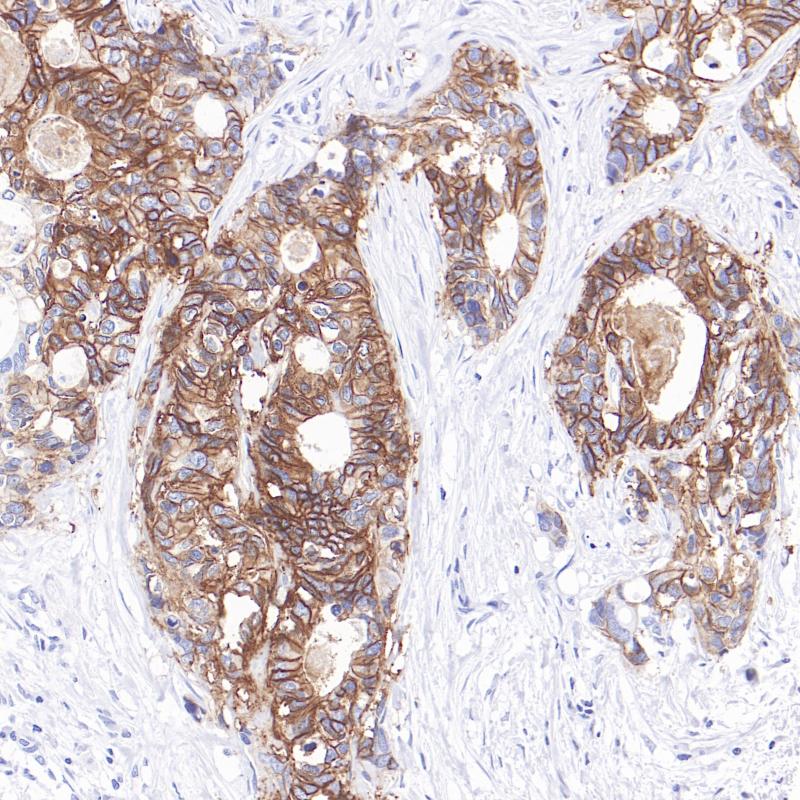 结肠癌GPA33(BP6325)染色