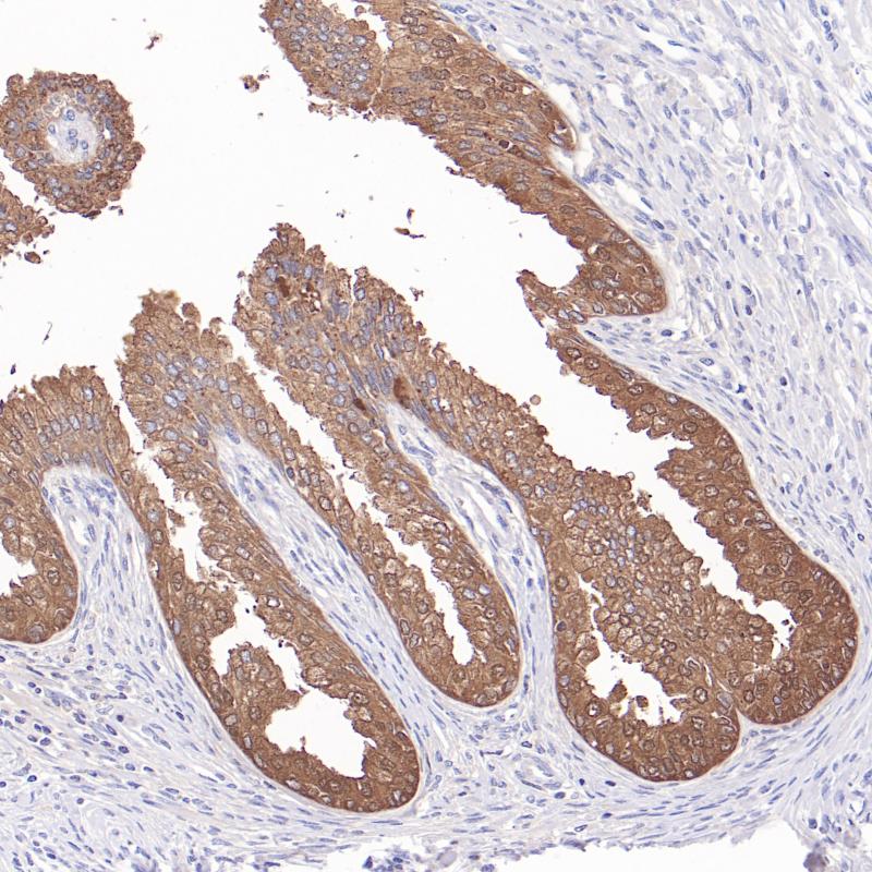 前列腺癌PAP(BP6329)染色
