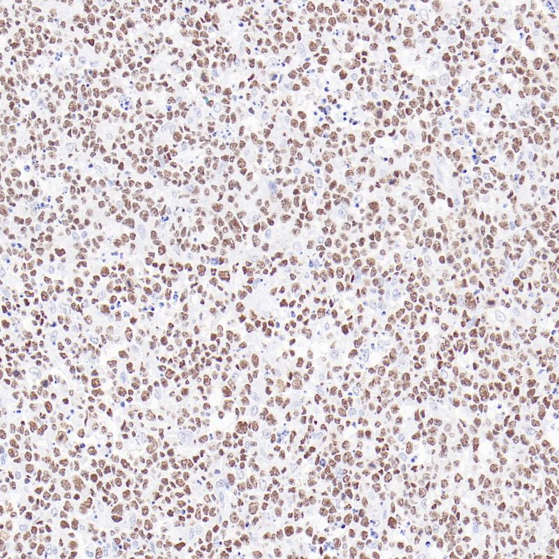 弥漫大B细胞淋巴瘤IKZF3(BP6333)染色