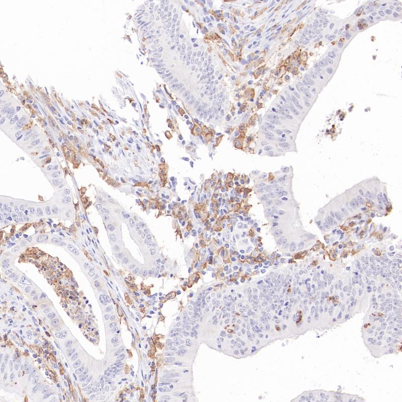 结肠癌CD16(BP6335)染色