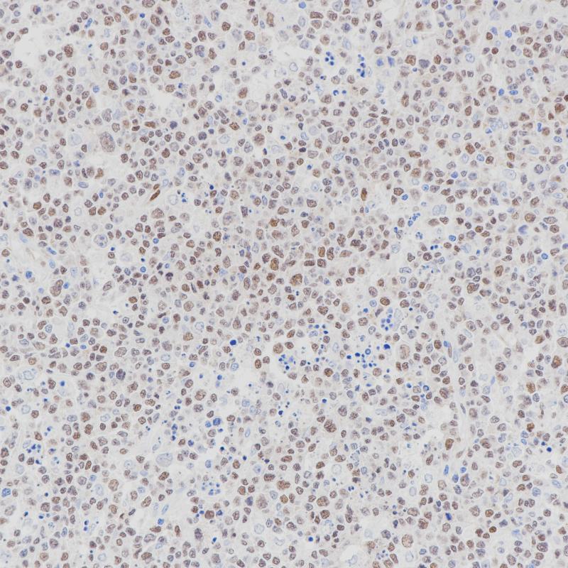弥漫大B淋巴瘤LMO2(BP6347)染色
